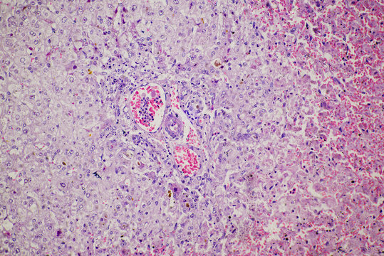 chronic obstruction of human liver