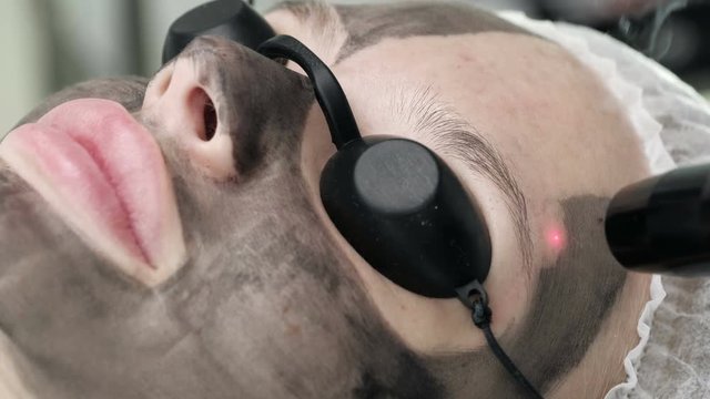 Carbon face peeling. Laser pulses clean the skin of the face. Hardware cosmetology. Facial skin rejuvenation.