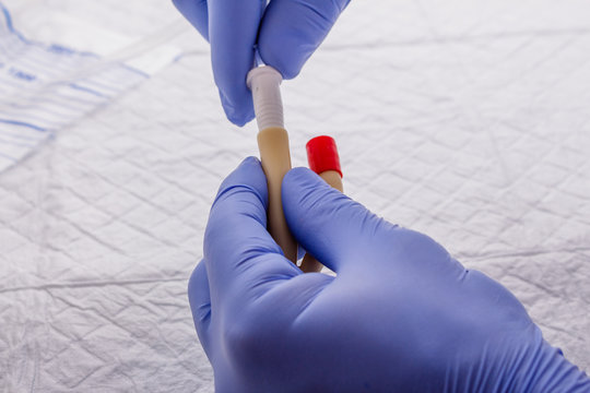 Nurse Inflates Urinary Catheter Bulb With Leg Drainage Bag On Sterile Field.