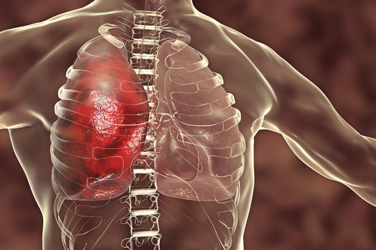 Pneumonia medical concept, 3D illustration showing lobar pneumonia of the right lung