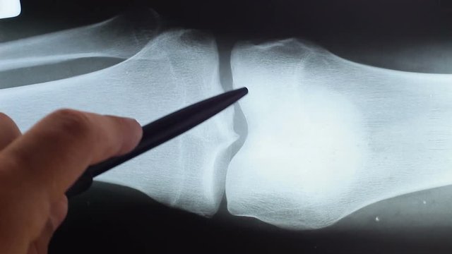 MRI or x-ray of the patient's knee with a meniscus injury
