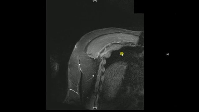 Real MRI Scan of Doctor examining male shoulder and finding a lesion, an oedema and the very rare paraglenodiale Cyst