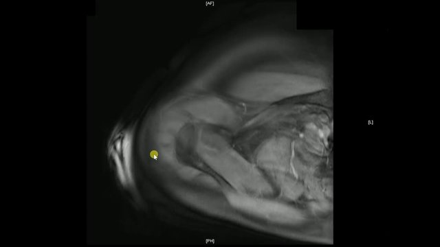 Real MRI Scan of Doctor examining male shoulder and finding a lesion, an oedema and the very rare paraglenodiale Cyst