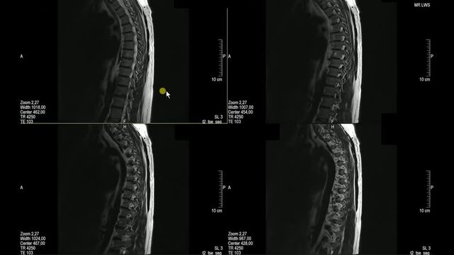 Real MRI Scan of Doctor examining the thoracic spine