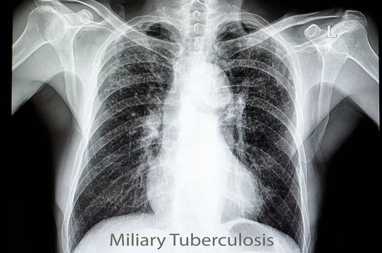 miliary pulmonary tuberculosis Stock Photo | Adobe Stock