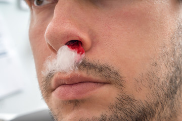 Young man with bleeding nose has cotton wool in nostril.