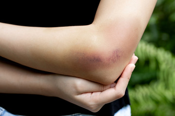 A teenager girl show a big purple bruise on her left arm that is caused by her accidentally fall...