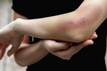 A teenager girl show a big purple bruise on her left arm that is caused by her accidentally fall...