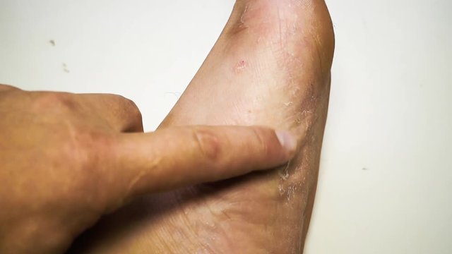 Hands scratching their feet with fungus