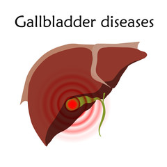 Gallbladder diseases, inflammation. Liver wit gallbladder. Anatomy vector flat illustration. White background.