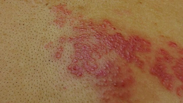 4k dolly shot, Herpes zoster skin disease caused by a virus that destroys the human nerve.
