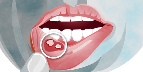 Afta, dolorosa ulcera all’interno della cavità orale. Labbra con afta. Rottura di una mucosa sulla bocca. Stomatite aftosa