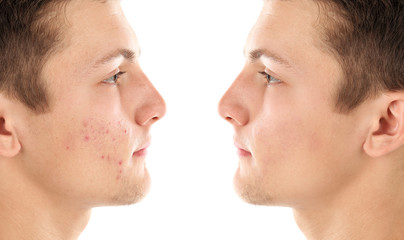 Young man with acne problem on white background