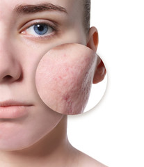 Young woman with acne problem on white background - obrazy, fototapety, plakaty