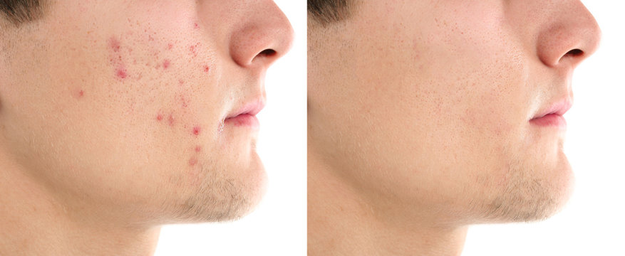 Young man with acne problem on white background