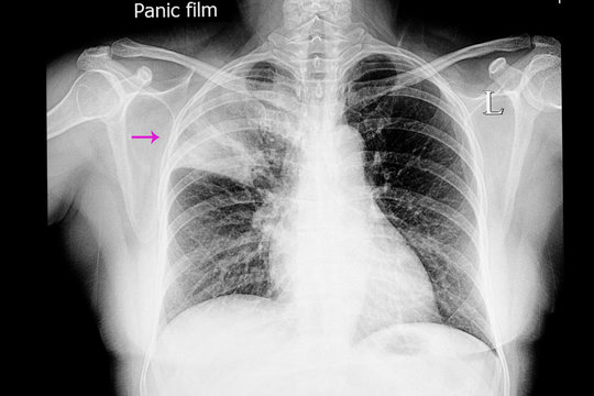 Lobar pneumonia
