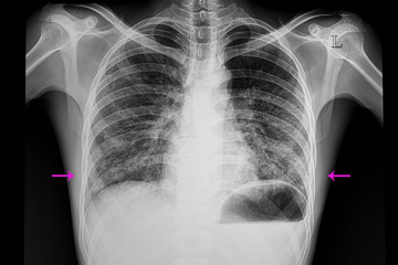 bilateral lower lungs pneumonia