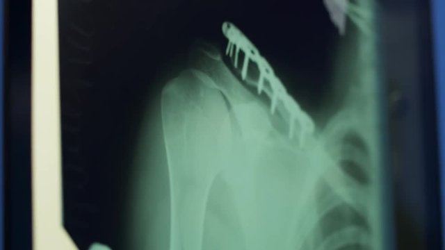 X-ray of collarbone