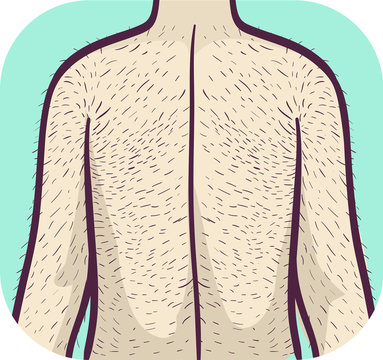 Symptoms Hairy Back Hypertrichosis Illustration