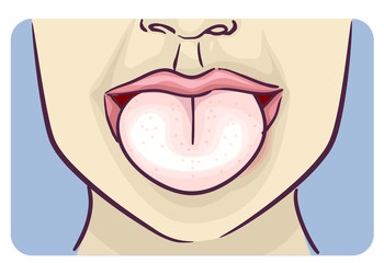 Symptoms Pale Tongue Illustration