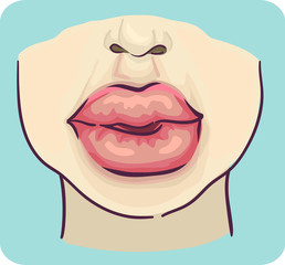 Symptoms Swelling Lips Illustration