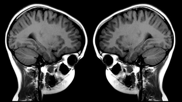 MRI of the brain. Fixates. Magnetic Resonance Imaging.
