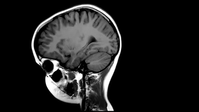 MRI brain scan,magnetic resonance imaging of a brain