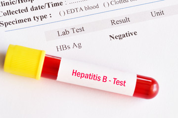 Hepatitis B virus negative test result with blood sample tube