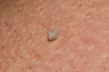 Birthmark of papilloma on the body of an old man close-up