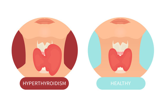 Woman with healthy thyroid gland and hyperthyroidism made in cartoon style. Front view sign. Human body organ anatomy icon. Medical concept. Vector illustration made in cartoon style.