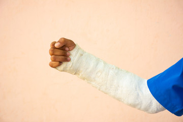 The arm was splinted due to a broken arm accident.