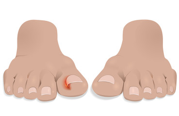 Nail disease. Ingrown nail. Onychocryptosis. 