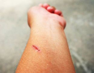 Wound dry Scab on skin of arm