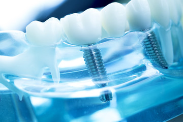 Dentist dental teeth implant