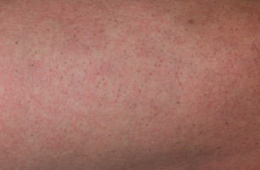 Fototapeta premium Zamknij ludzką skórę z czerwonymi wysypkami spowodowanymi chorobą denga