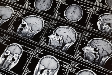 Magnetic resonance scan of the brain. MRI head scan