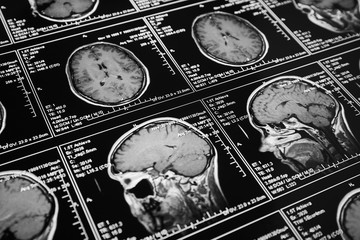 Magnetic resonance scan of the brain. MRI head scan