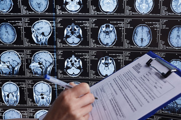Magnetic resonance scan of the brain. MRI head scan