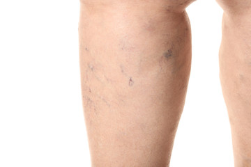 Woman's leg with varicose on white background, closeup