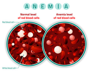 Anemia level of blood cells - obrazy, fototapety, plakaty
