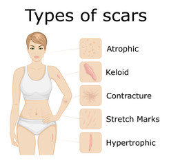 Types of scars