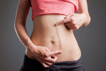 Woman with long abdominal scars after operation