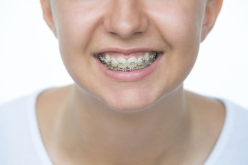 Face of a young woman with braces on her teeth . Healthy smile. Healthcare and medicine
