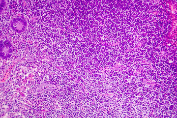 Suppurative appendicitis, light micrograph, photo under microscope showing neutrophilic infiltrates of the appendix wall