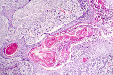 Squamous cell carcinoma, light micrograph, photo under microscope showing typical keratinous pearls