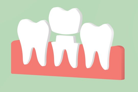 dental crown, installation process and change of teeth - tooth cartoon 3d render