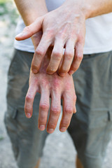 The problem of many people - eczema on hand. Street background. Man itchind psoriasis skin with red...