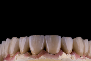 Fototapeta na wymiar dental crowns and veneers