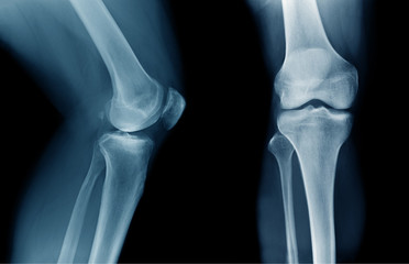 x-ray OA knee x-ray