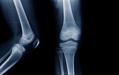 x-ray children knee